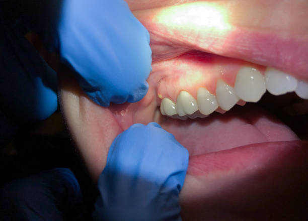 Best Emergency Tooth Extraction  in Crofton, MD